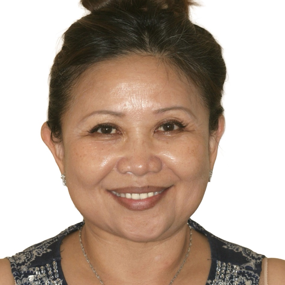 Patient smile before treatment