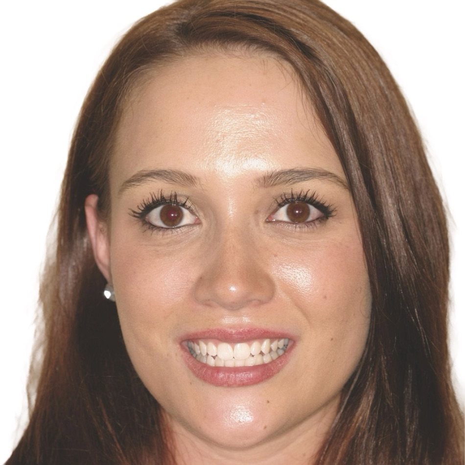 Patient smile before treatment