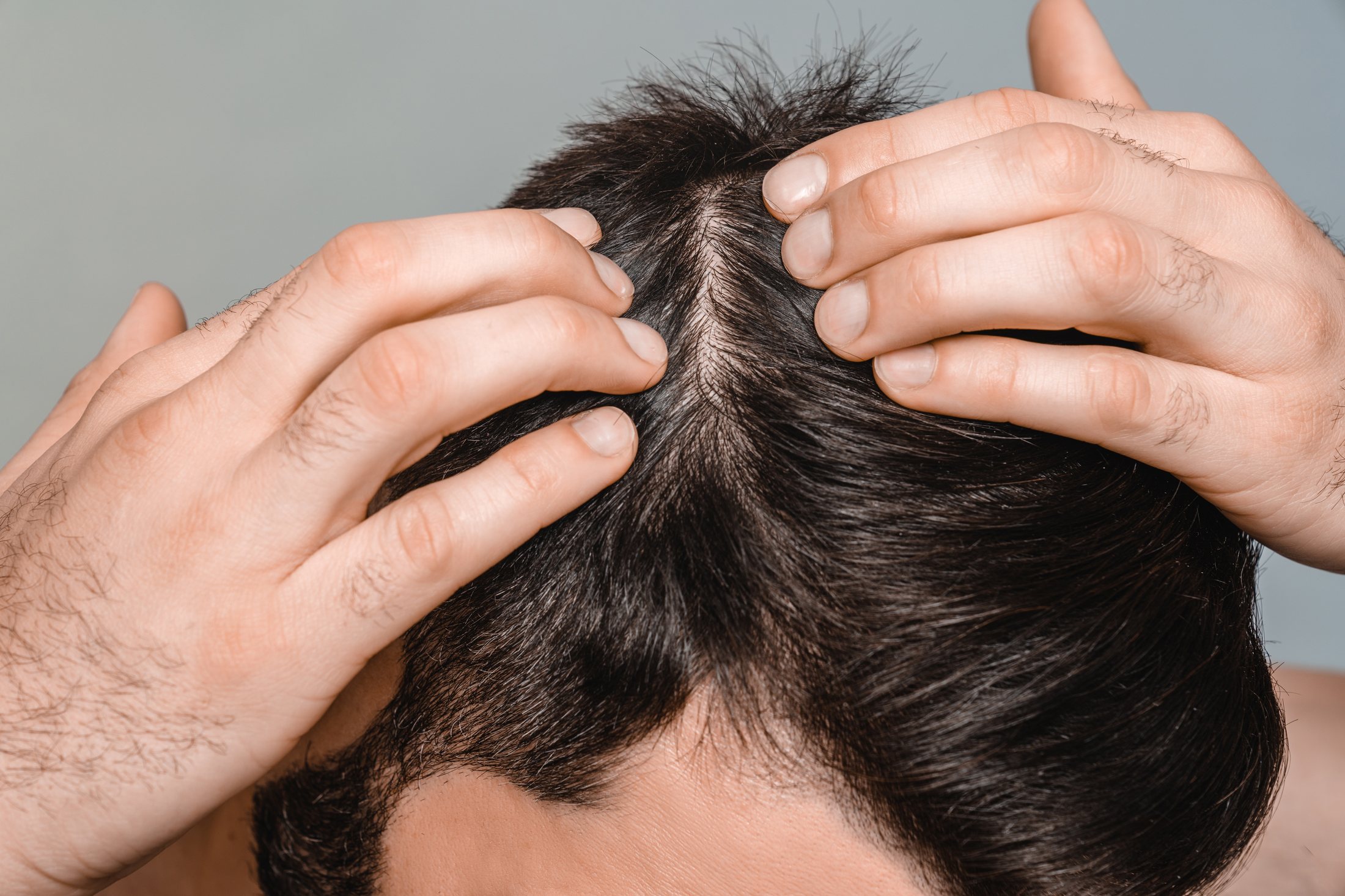 Hair Restoration at Aviara