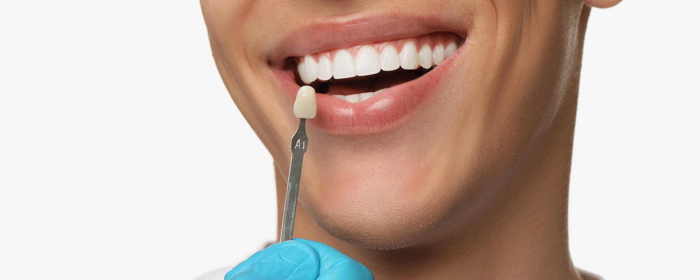 Matching a veneer shade to a natural smile